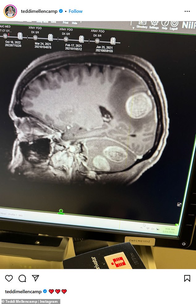 Teddi Mellencamp after brain tumor surgery; undergoing radiation and immunotherapy