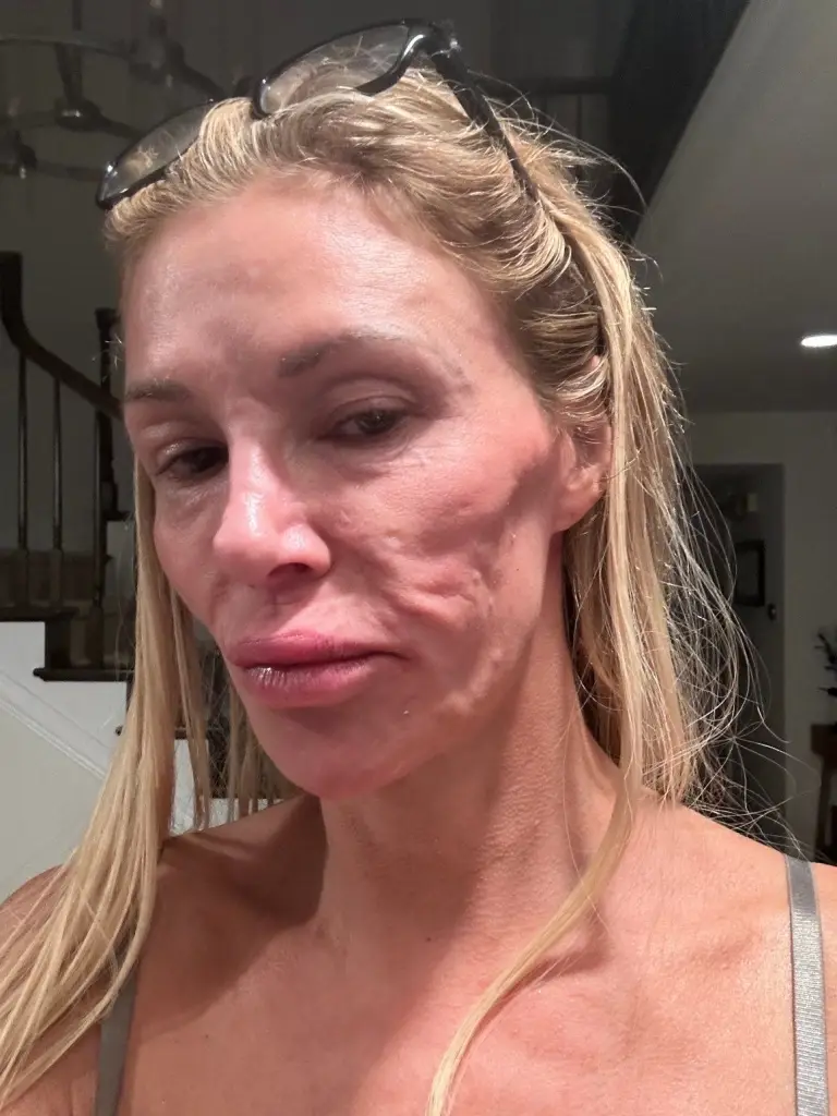 Brandi Glanville with visible facial scars and irritation.