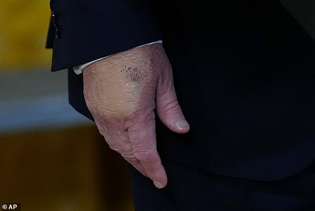 Close-up of Trump's hand with visible bruising, sometimes concealed with makeup or bandages