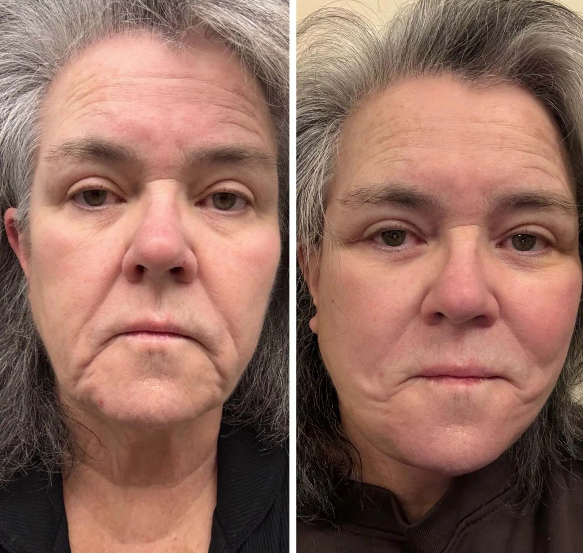 Collage of before and after close-up images of Rosie O'Donnell's face, showing the effects of a facelift.